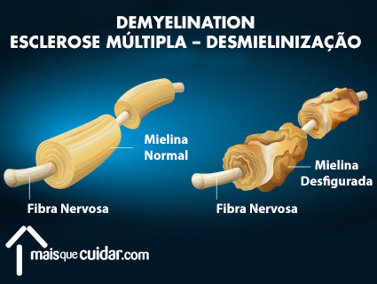 esclerose múltipla desmielinização bainha de mielina dos neurônios danificada