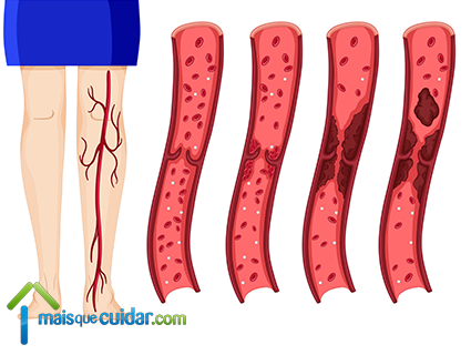 pernas com trombose problema na circulacao de sangue