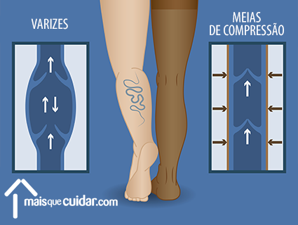 Varizes e meias de compressão