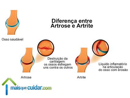 qual diferença artrite e artrose