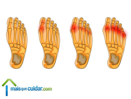 artrose dedos pés sintomas