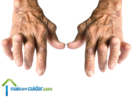 artrite reumatóide nas mãos foto