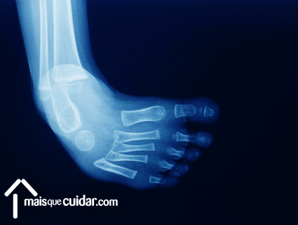 artrose doença congénita causas osteoartrite