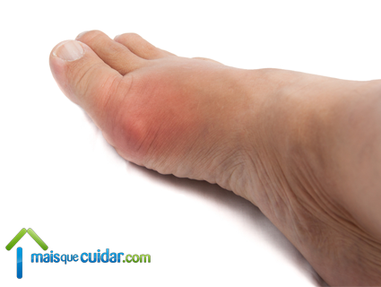doença gota nos pés dor nas articulações