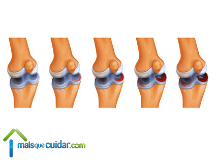 artrose no joelho gonartrose sintomas