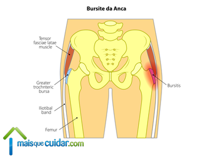 bursite trocantérica na anca