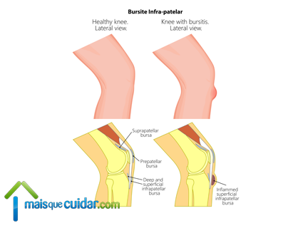 rótula joelho bursite infrapatelar