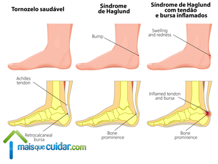 bursite retrocalcânea bursite posterior tendão calcâneo