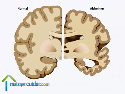 cérebro com alzheimer e normal