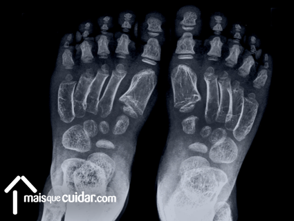malformação congénita pés joanete