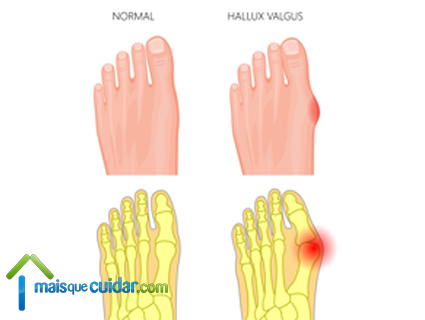 joanete hallux valgus o que é