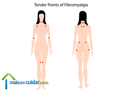 fibromialgia sintomas pontos dolorosos