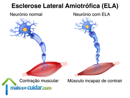 esclerose lateral amiotrófica o que é ela