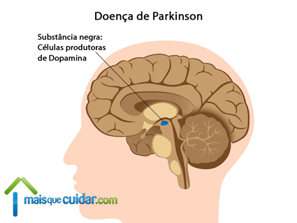 cérebro doença parkinson o que é