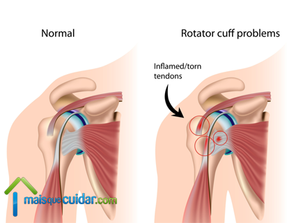tendinite manguito rotador ombro