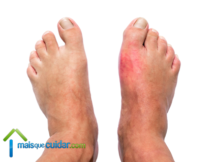 gota doença fotos pés artrite gotosa