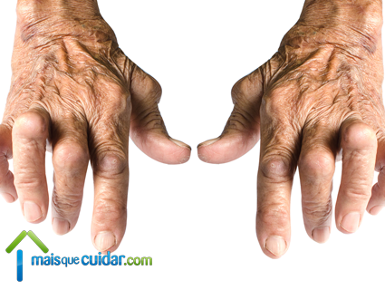 artrite reumatoide mãos pulsos dedos