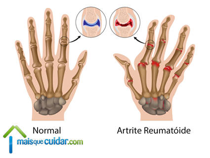 artrite reumatoide inflamação articular