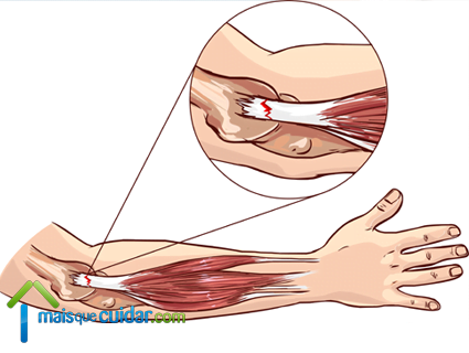 tendão medial epicondilite lateral