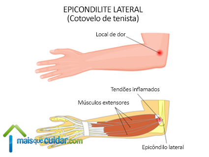 epicondilite lateral dor cotovelo inflamação