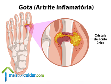 gota ácido úrico artrite inflamatória