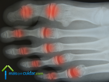 radiografia artrite reumatoide exames