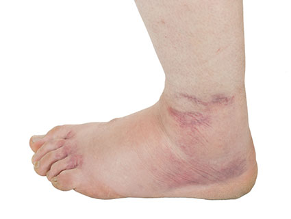 tornozelo inchado sintomas entorses