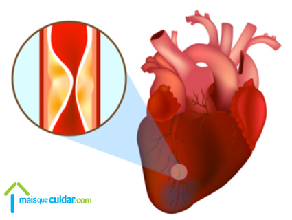 enfarte agudo miocárdio ataque coração