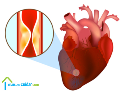 Enfarte agudo do miocárdio ou Ataque Cardíaco (coração)