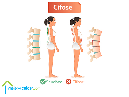o que é cifose curvatura coluna