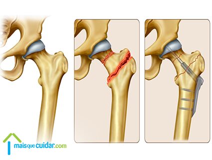 fratura do colo do femur imagem