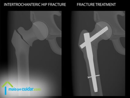 Cirurgia para fratura do fémur Rx