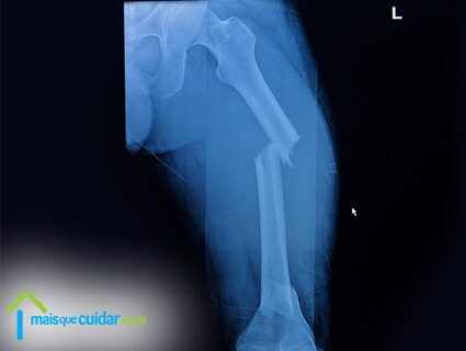 Diagnóstico de fratura do fémur