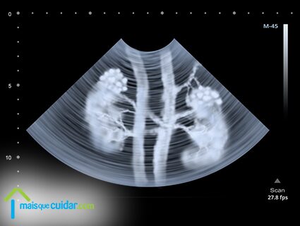 Ecografia dos rins com insuficiência renal