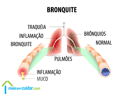 Bonquite o que é Bronquite o que é