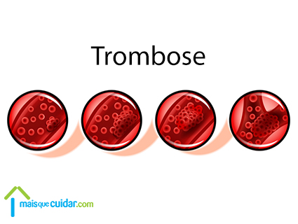 trombose o que é trombose o que é