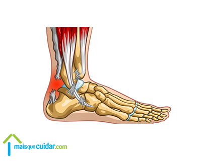 Lesões frequentes do Tendão de Aquiles