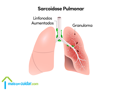 Sarcoidose pulmonar o que é