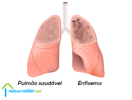 Enfisema pulmonar o que é Enfisema pulmonar o que é