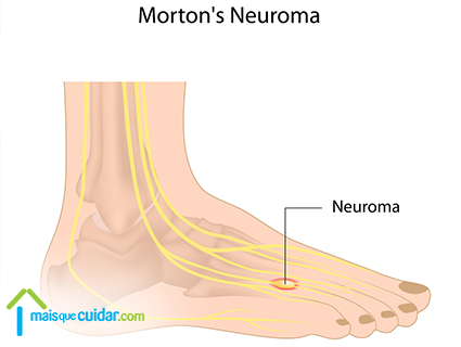 Neuroma de Morton o que é Neuroma de Morton o que é