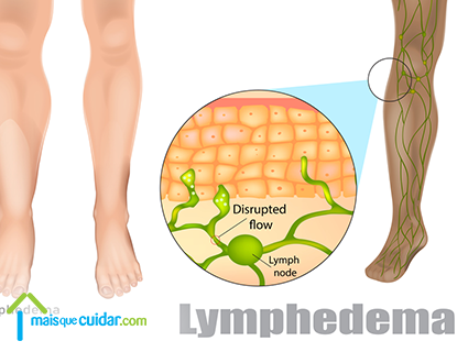 Linfedema o que é Linfedema o que é