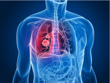 Terapia fotodinâmica para cancro pulmão
