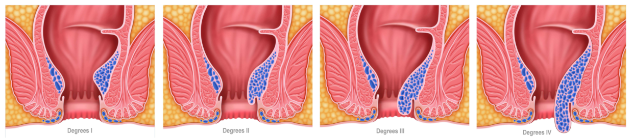 Graus das hemorroidas internas